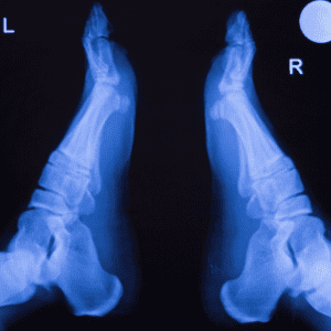 ankle x ray - heel lift